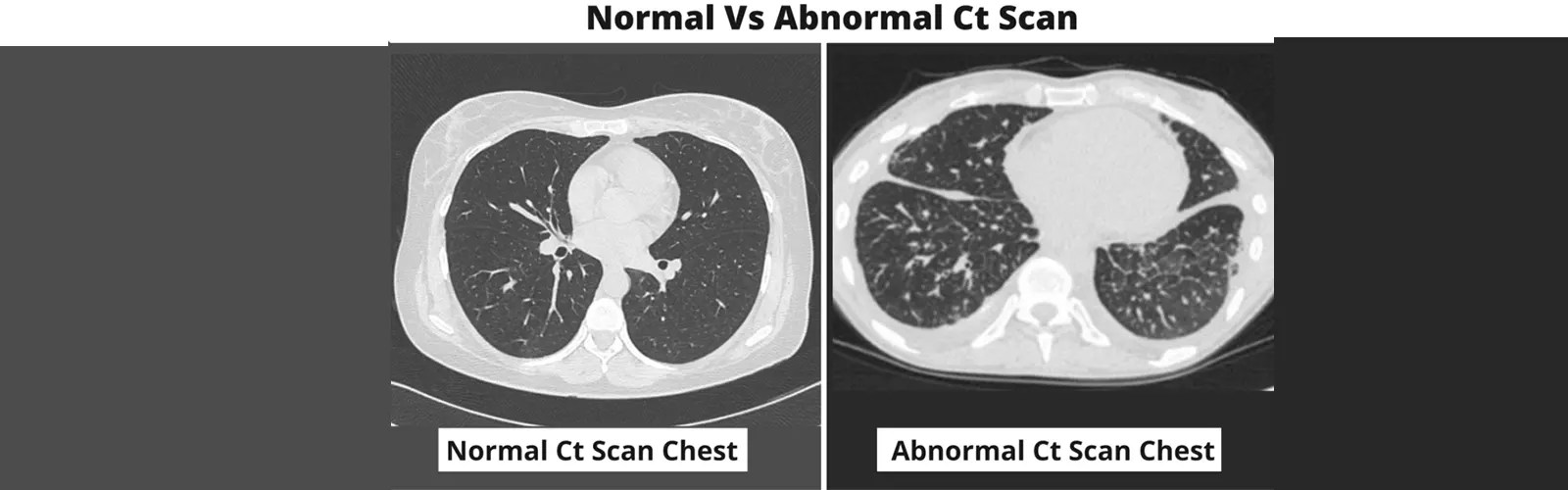 What is NCCT Chest?